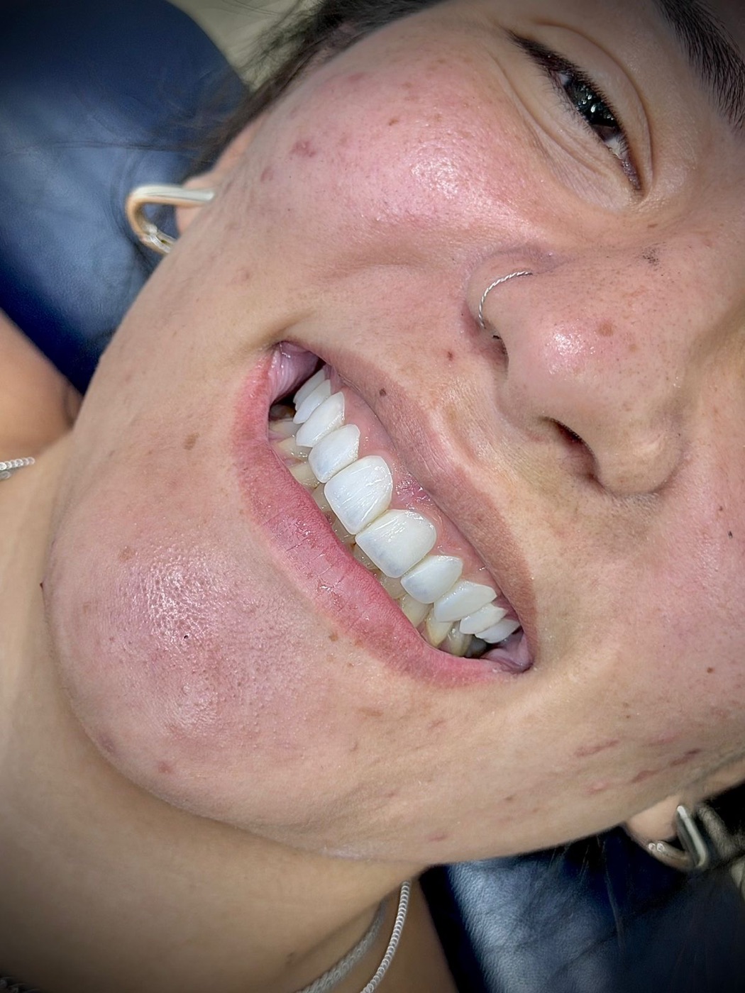 Sorriso transformado com facetas em resina na RICCO Taguatinga