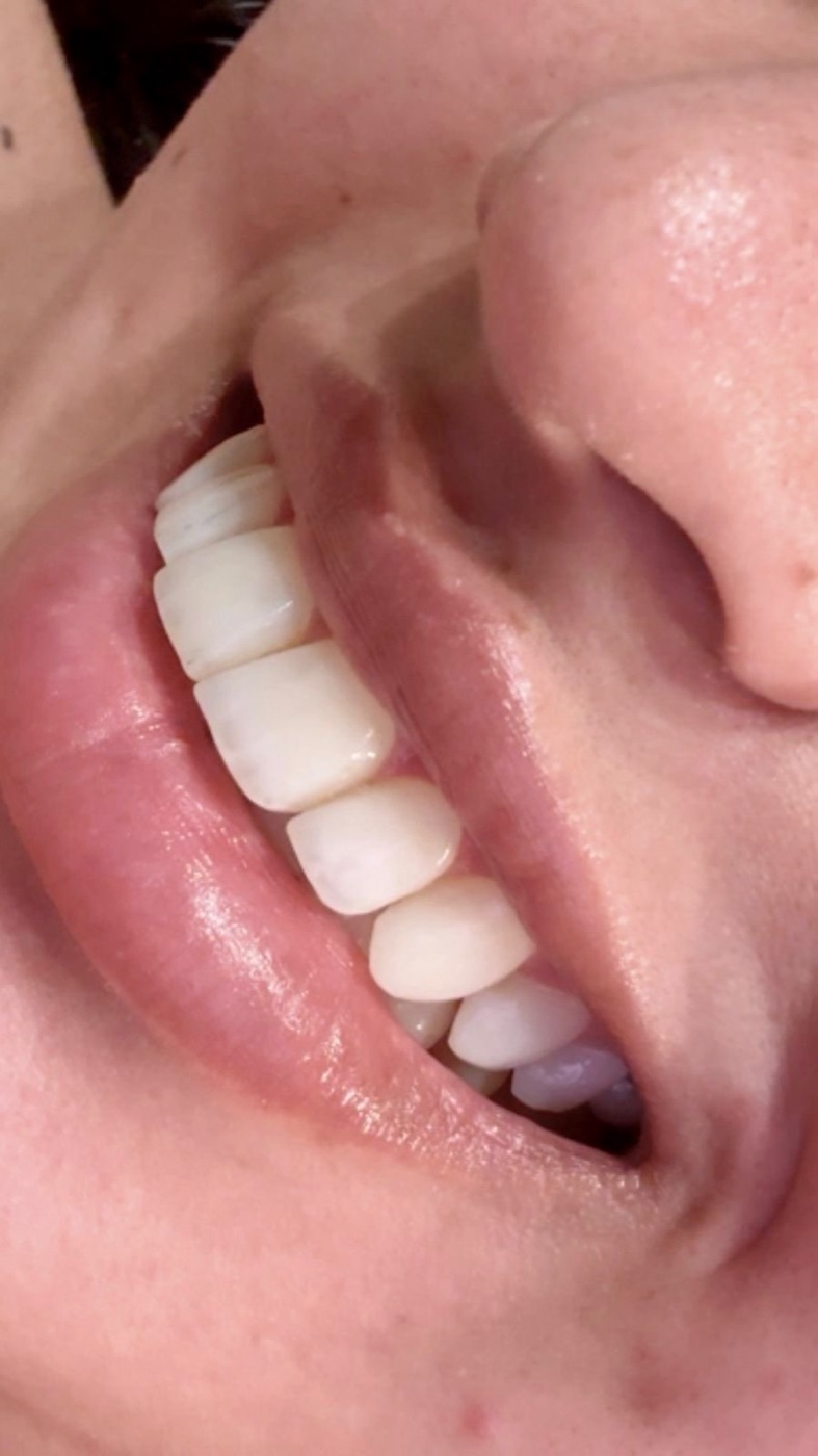Facetas em resina esculpidas à mão pelo Dr. Thauan Lafayette