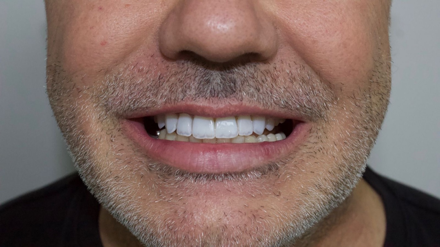 Sorriso renovado com facetas em resina na RICCO Taguatinga