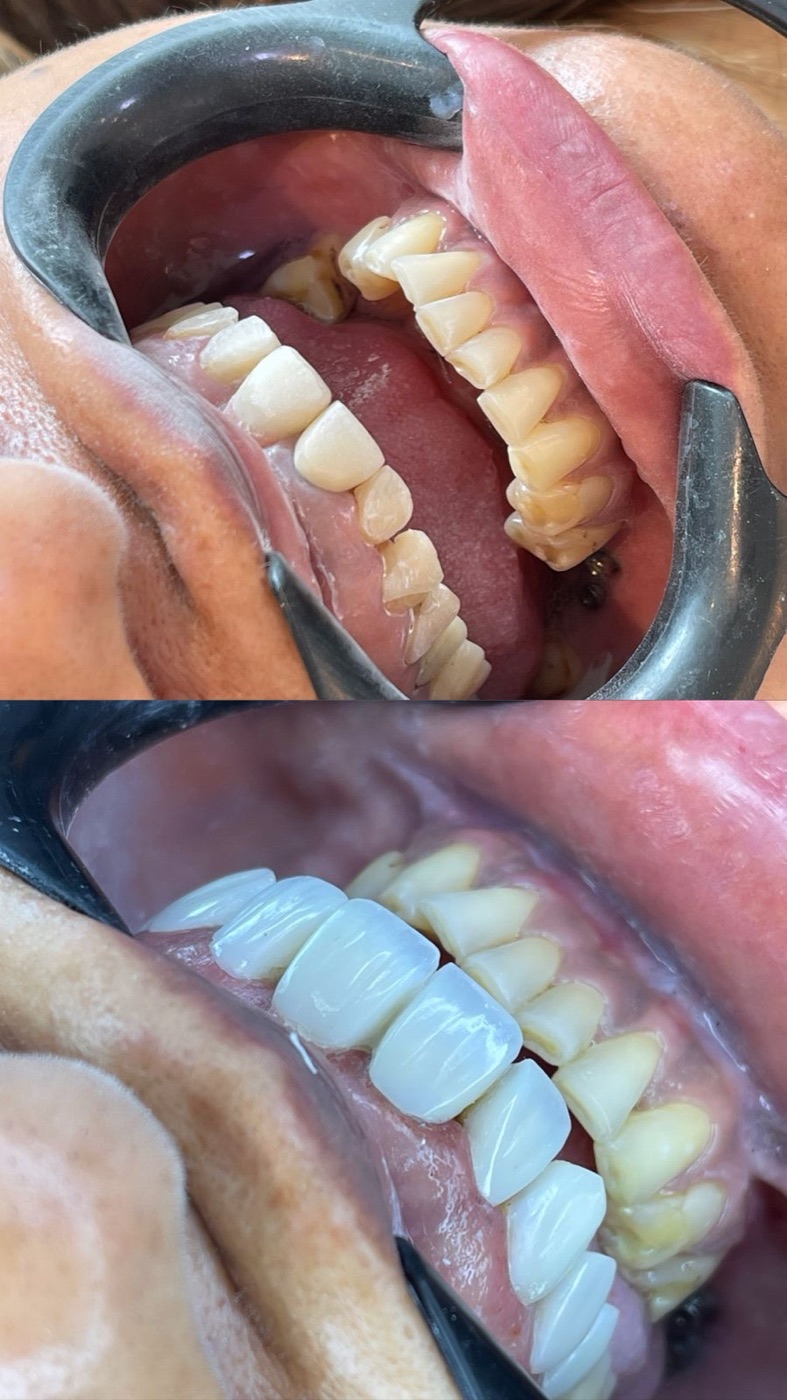 Antes e depois de facetas em resina com o Dr. Thauan Lafayette na RICCO, Taguatinga
